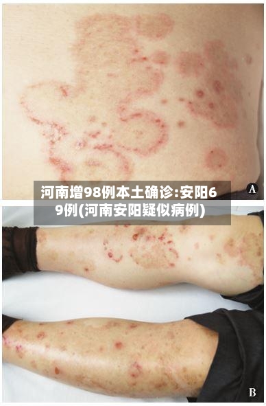 河南增98例本土确诊:安阳69例(河南安阳疑似病例)